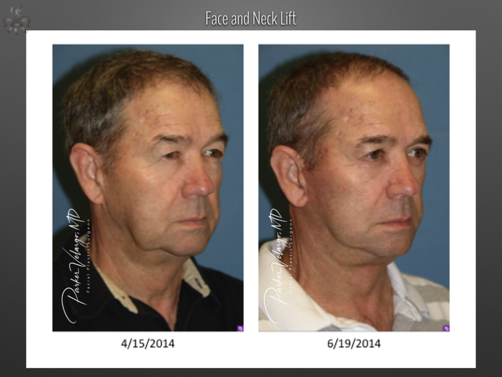 Face/Neck Lift before and after