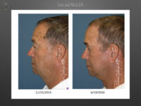 Face/Neck Lift before and after
