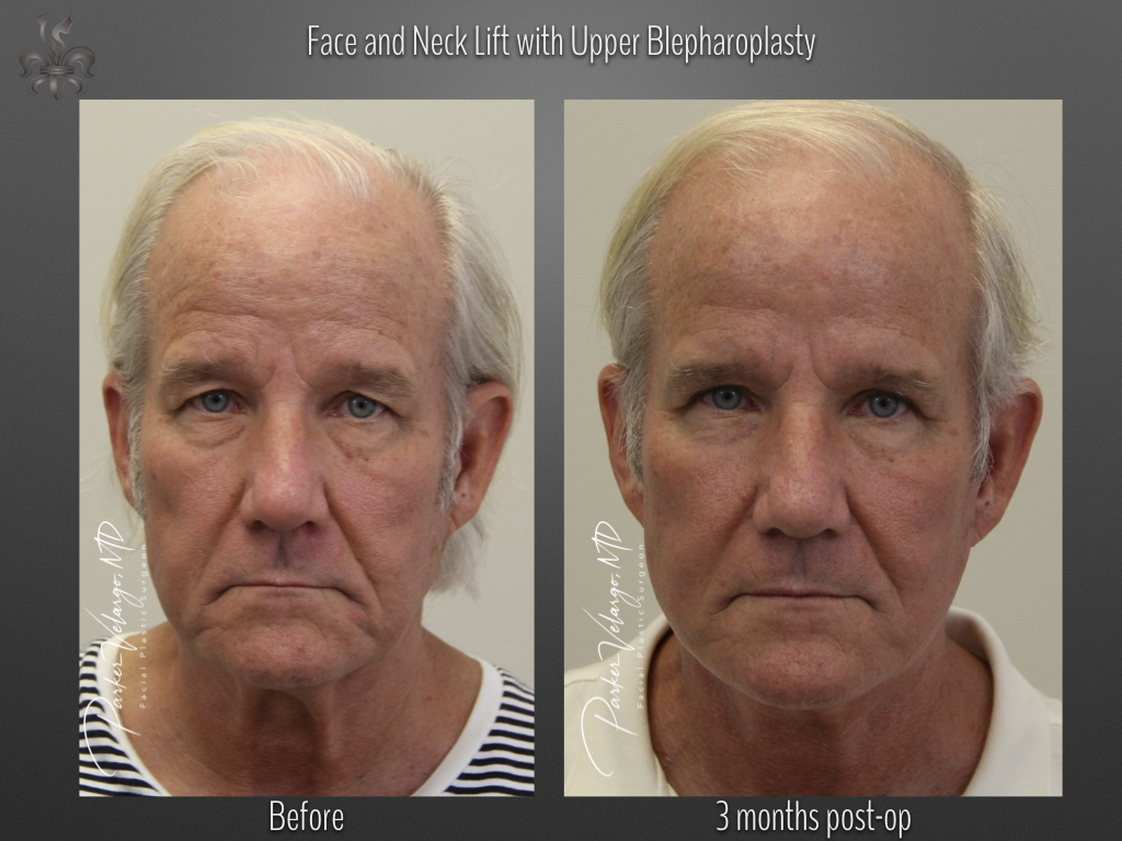 Face/Neck Lift before and after
