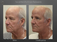 Face/Neck Lift before and after