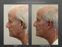 Face/Neck Lift before and after