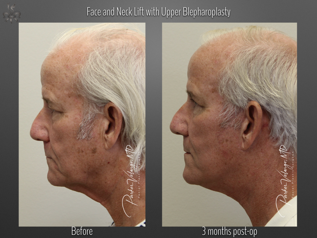 Face/Neck Lift before and after