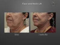 Face/Neck Lift before and after