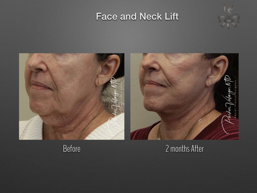 Face/Neck Lift before and after
