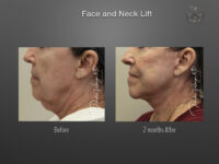 Face/Neck Lift before and after