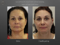 Face/Neck Lift before and after