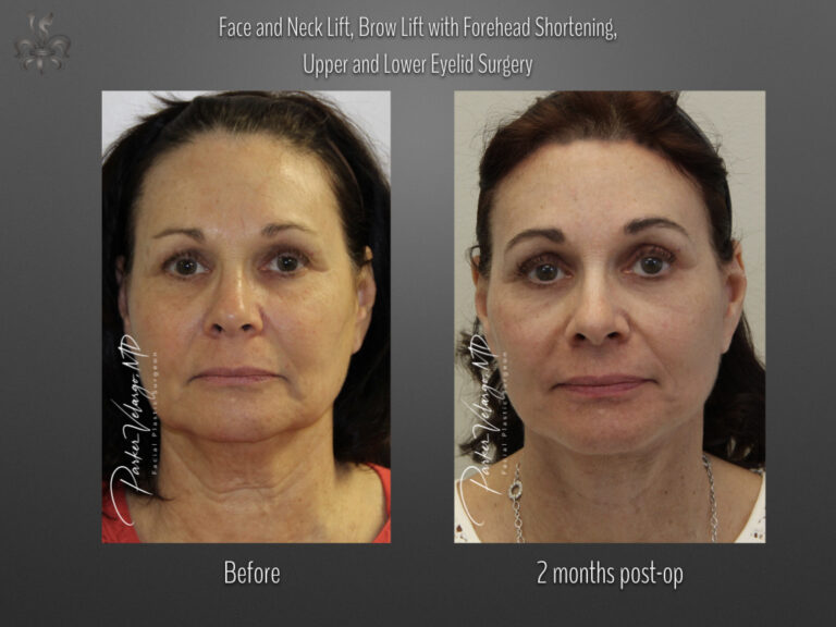 Face/Neck Lift before and after