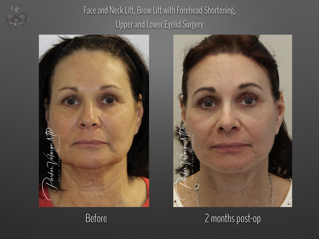 Face/Neck Lift before and after