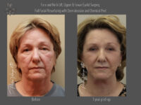 Face/Neck Lift before and after