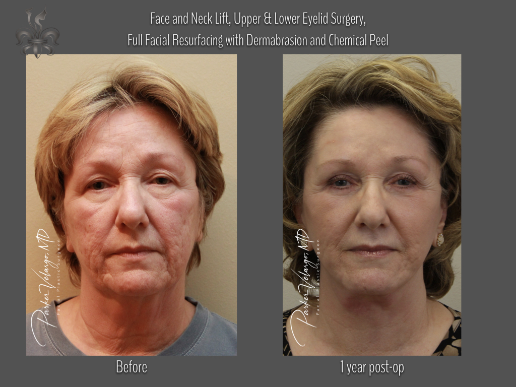 Face/Neck Lift before and after