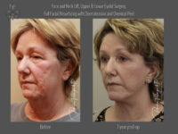 Face/Neck Lift before and after