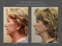 Face/Neck Lift before and after