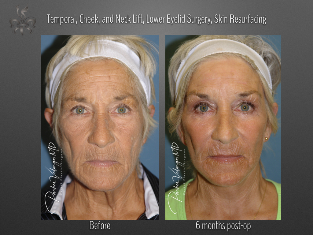 Face/Neck Lift before and after