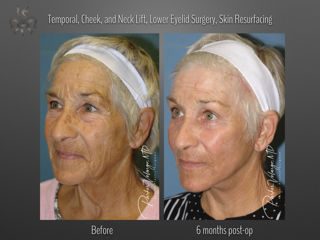 Face/Neck Lift before and after