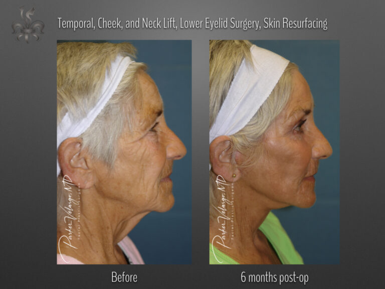 Face/Neck Lift before and after