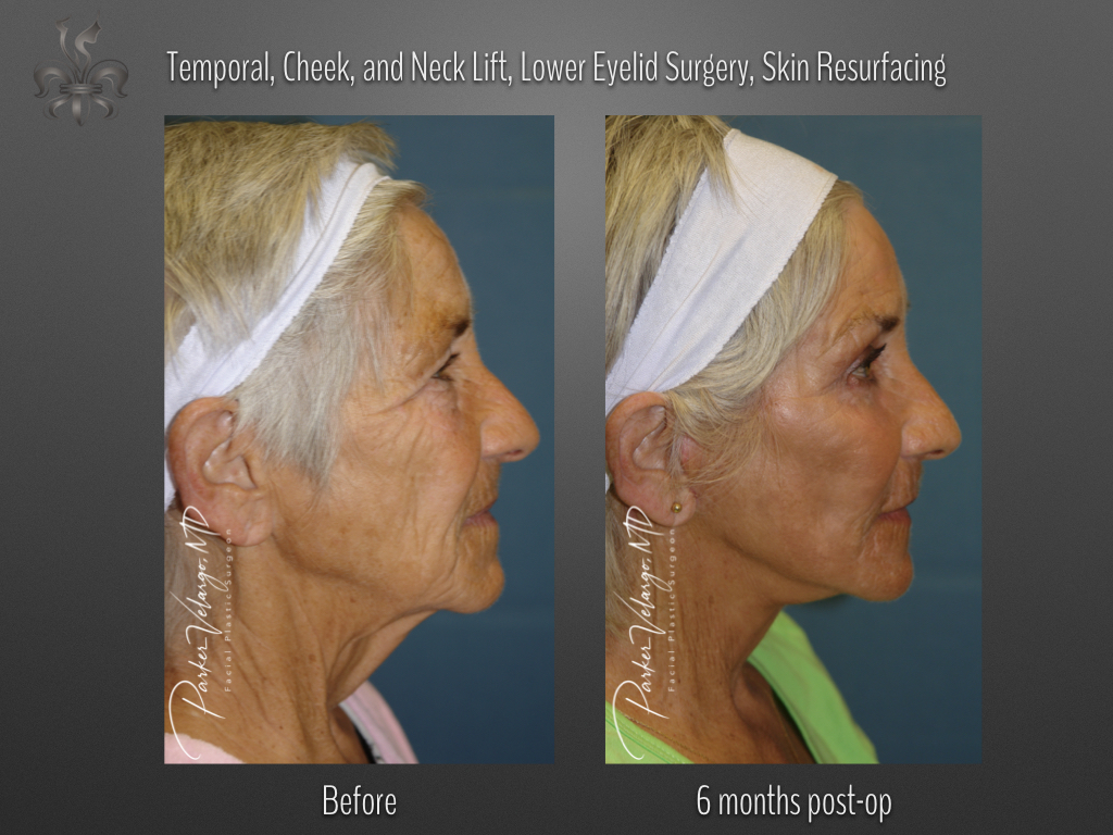 Face/Neck Lift before and after
