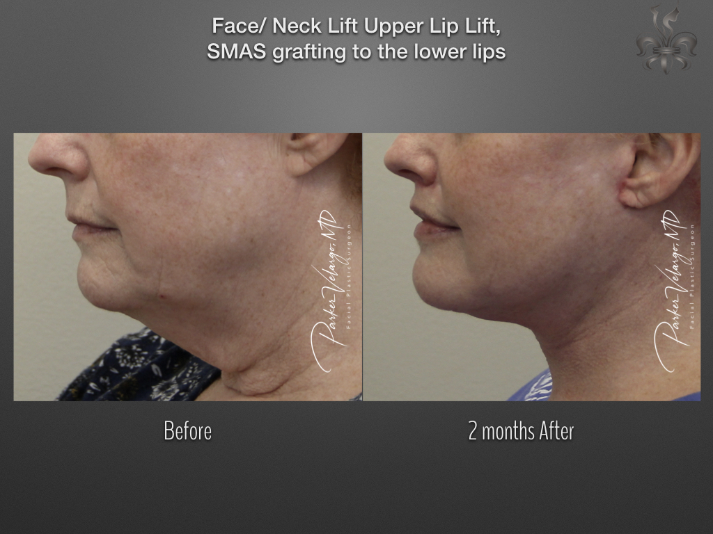 Face/Neck Lift before and after