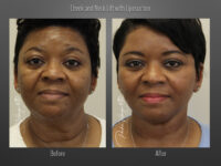 Face/Neck Lift before and after
