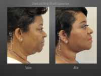 Face/Neck Lift before and after