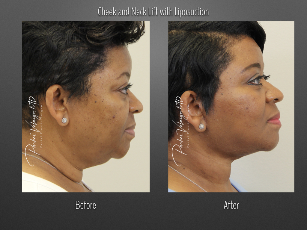 Face/Neck Lift before and after