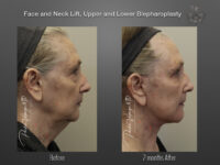 Face/Neck Lift before and after