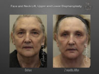 Face/Neck Lift before and after