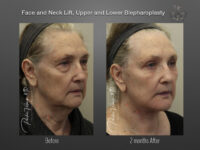Face/Neck Lift before and after