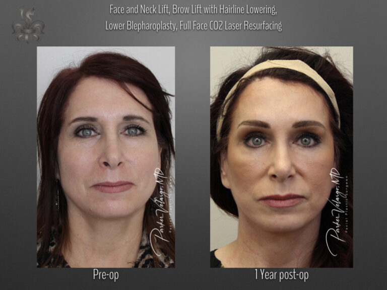 Face/Neck Lift before and after