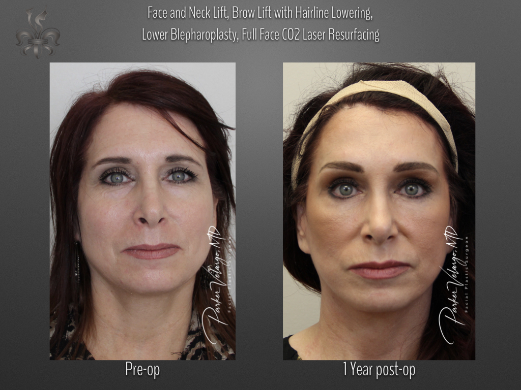 Face/Neck Lift before and after