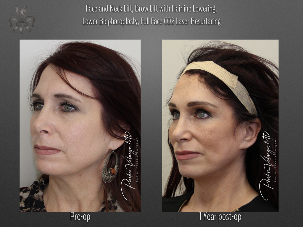 Face/Neck Lift before and after