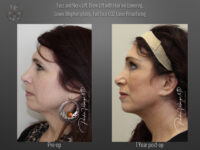 Face/Neck Lift before and after
