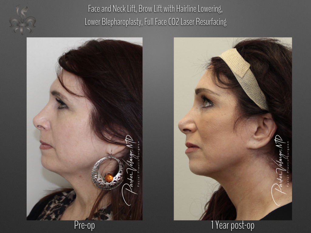 Face/Neck Lift before and after