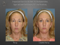Face/Neck Lift before and after