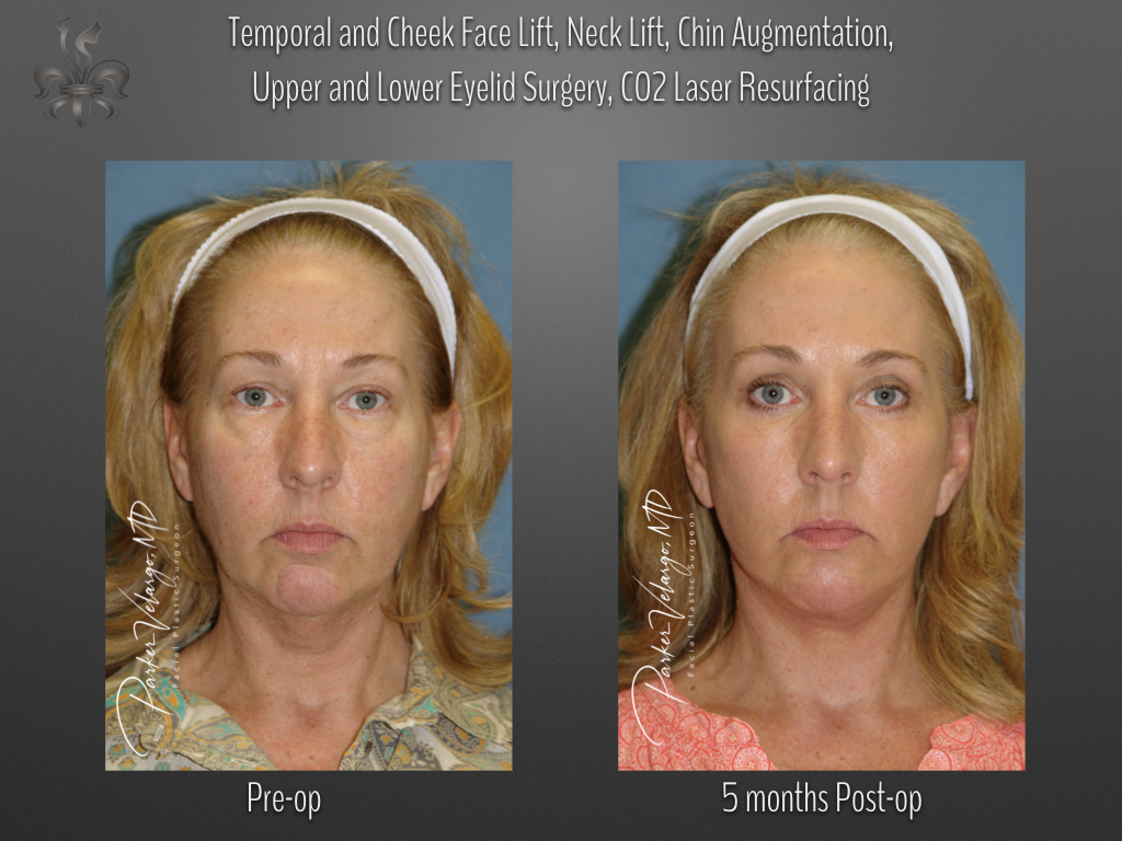 Face/Neck Lift before and after