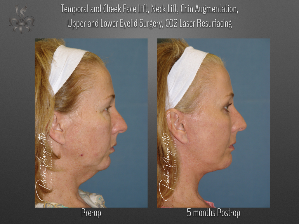 Face/Neck Lift before and after