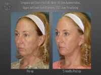Face/Neck Lift before and after