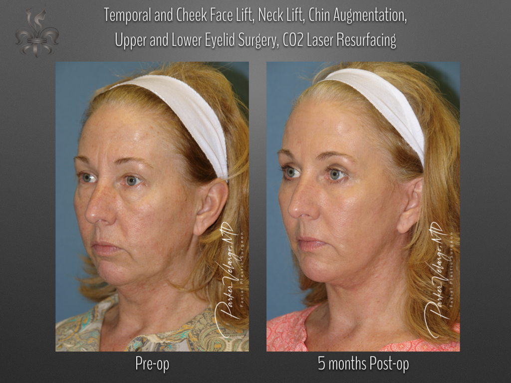 Face/Neck Lift before and after