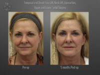 Face/Neck Lift before and after
