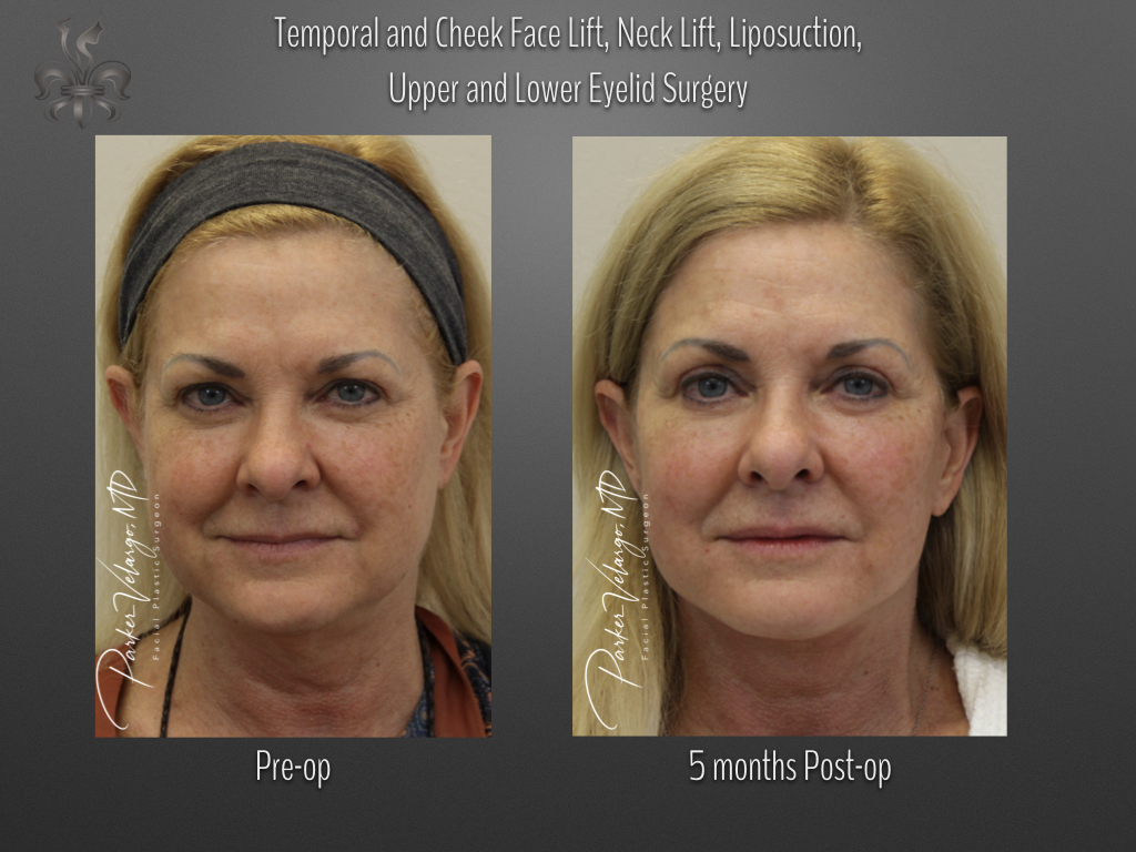 Face/Neck Lift before and after
