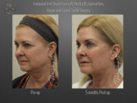 Face/Neck Lift before and after