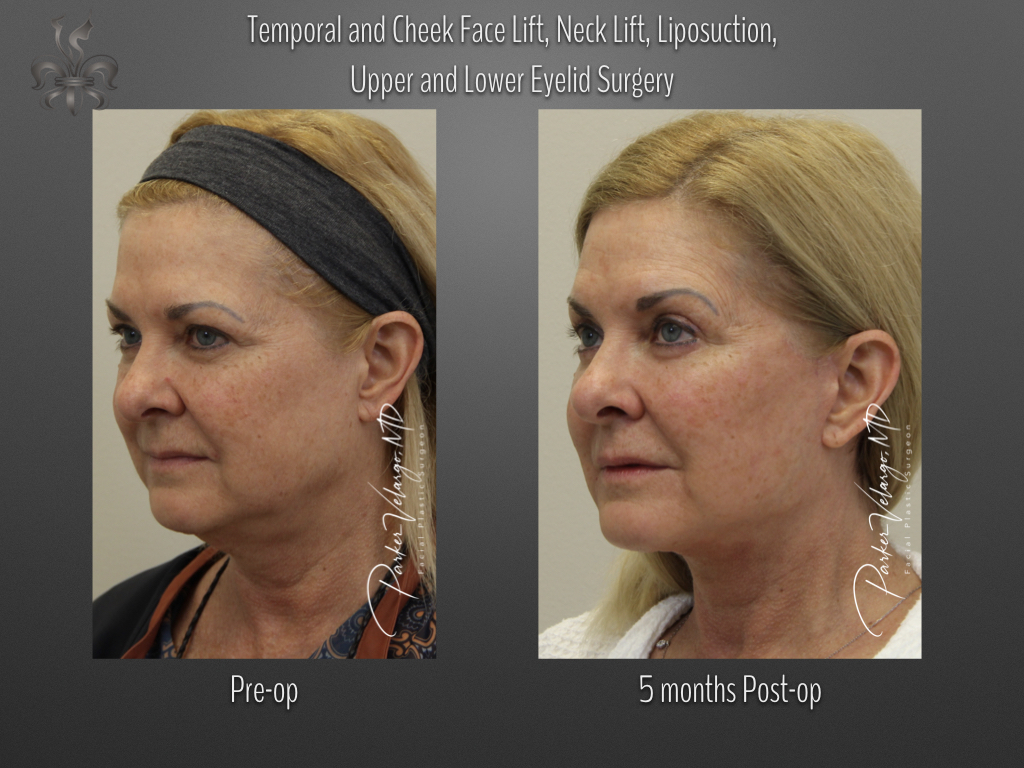 Face/Neck Lift before and after
