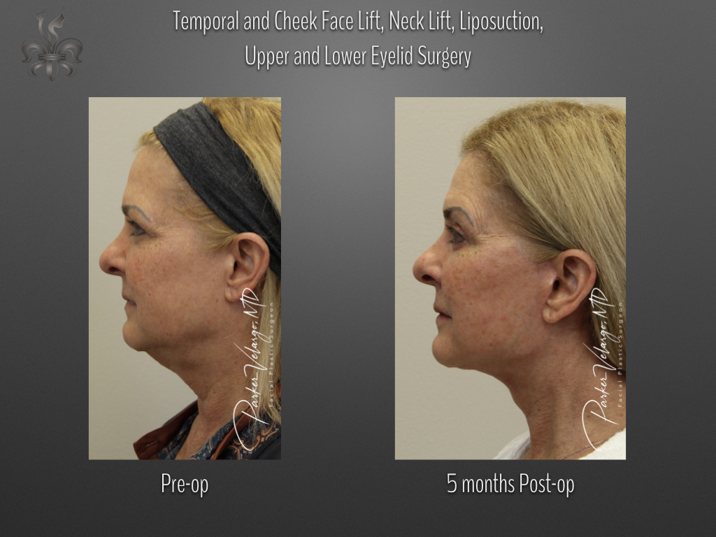 Face/Neck Lift before and after