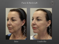 Face/Neck Lift before and after