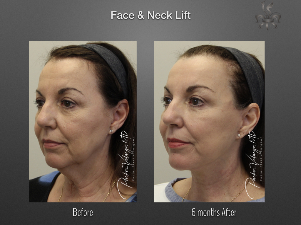 Face/Neck Lift before and after