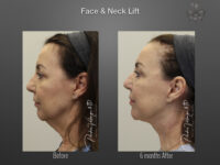 Face/Neck Lift before and after