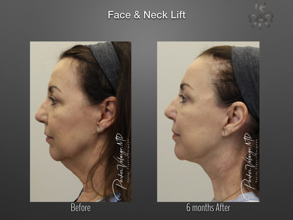 Face/Neck Lift before and after