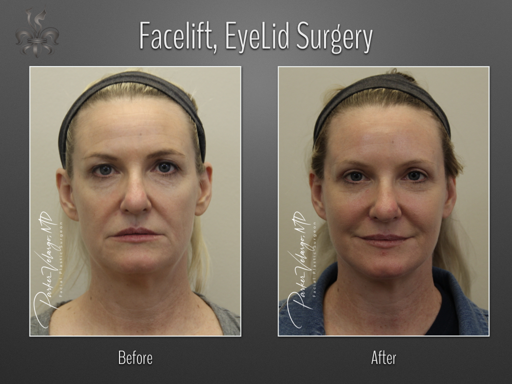 Face/Neck Lift before and after