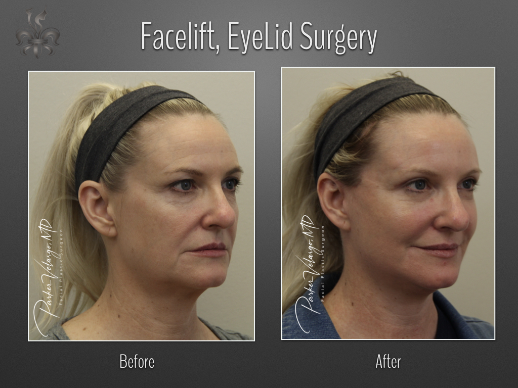 Face/Neck Lift before and after