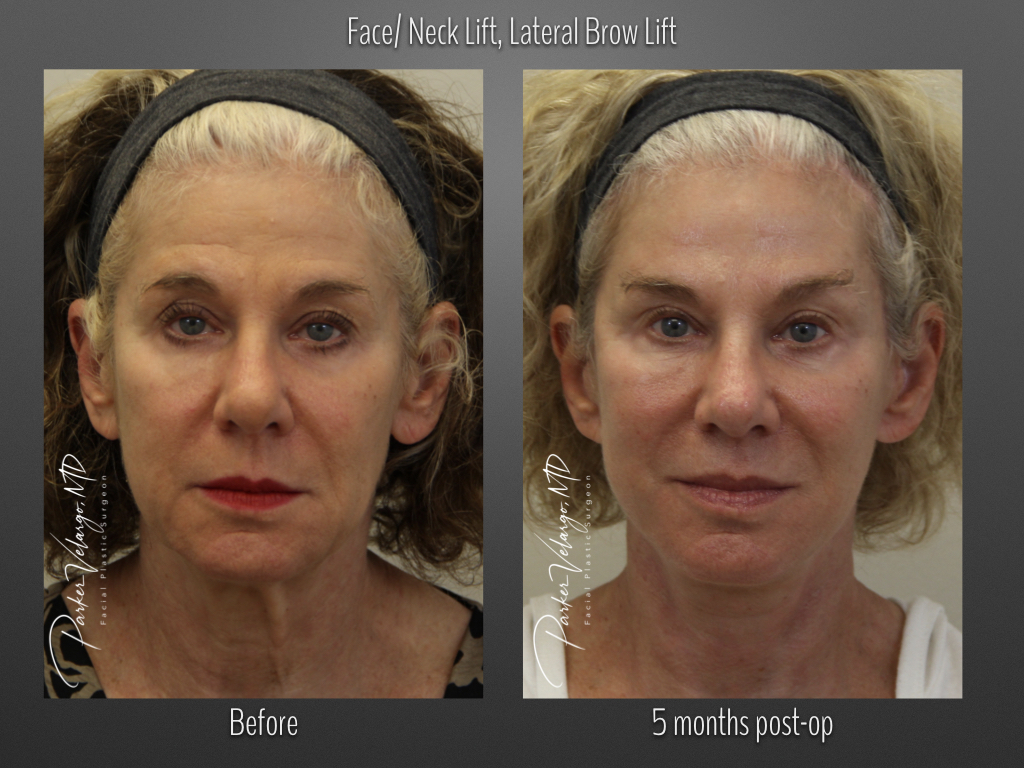 Face/Neck Lift before and after