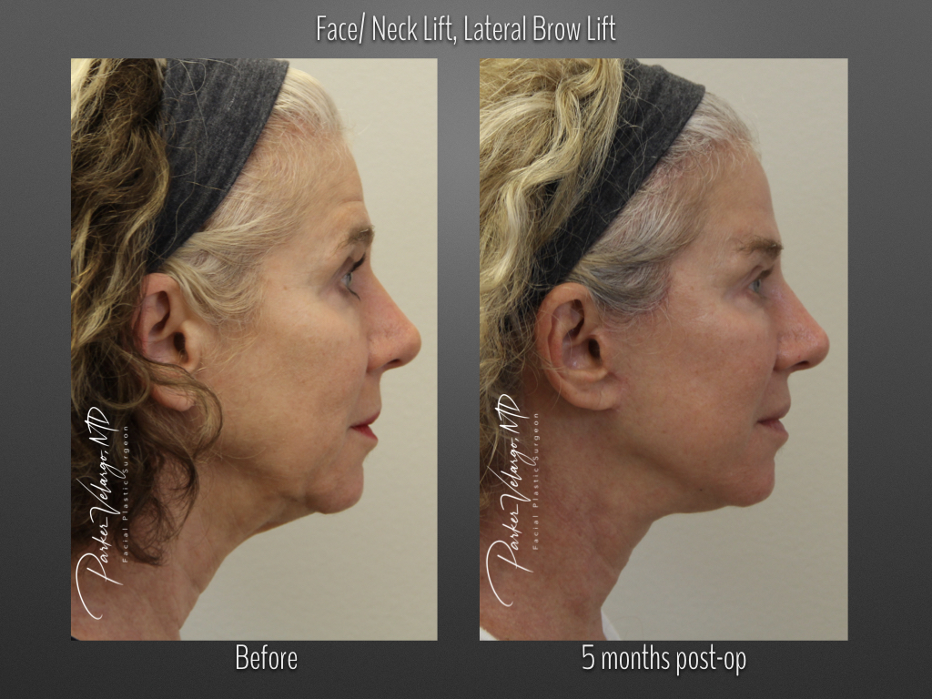 Face/Neck Lift before and after